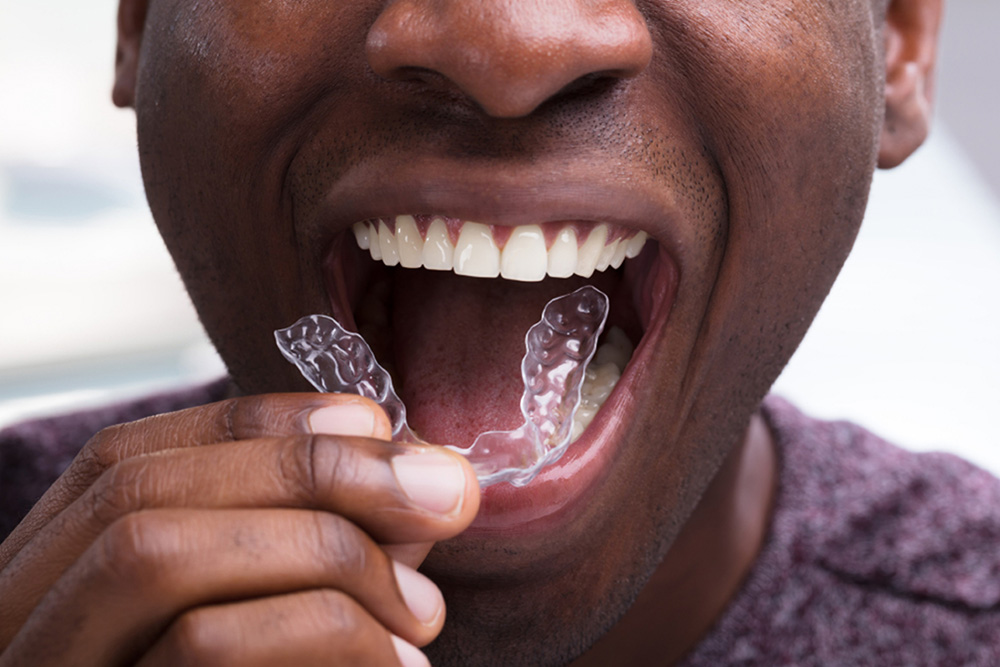 invisalign in sw calgary