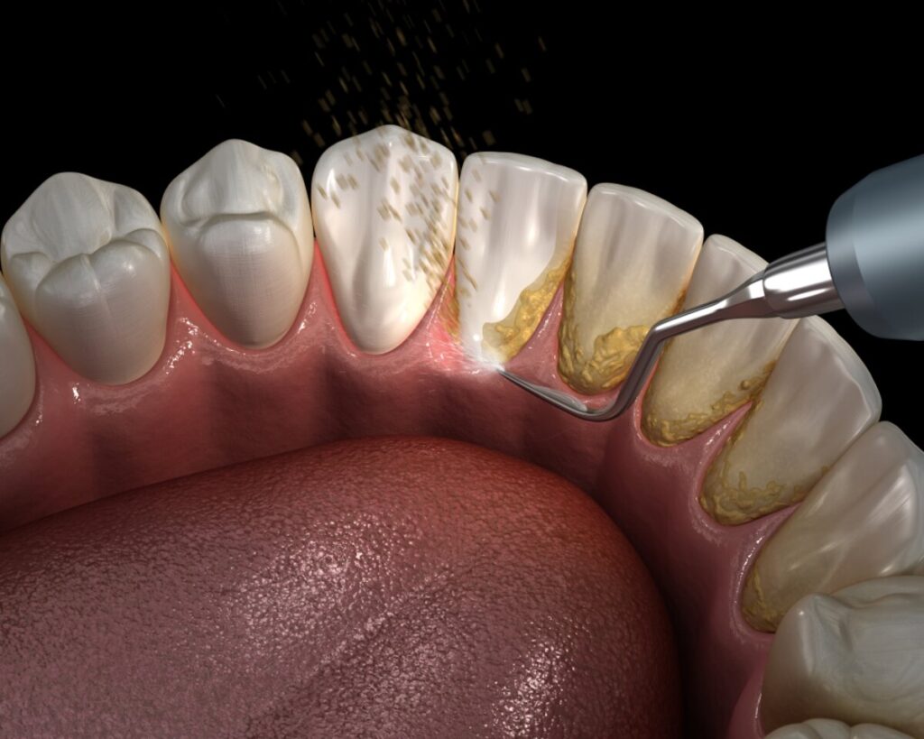 what is the difference between scaling and cleaning teeth